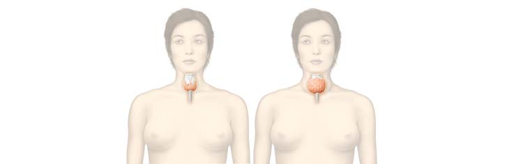 Hashimoto-Thyreoiditis