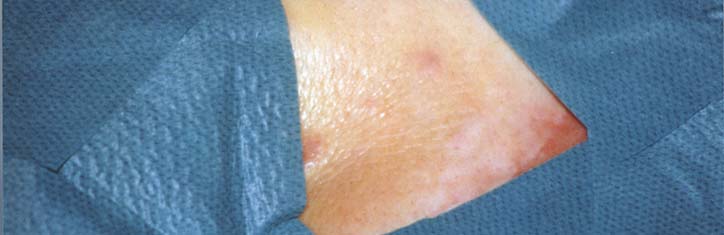 Wie man Tumore ohne Skalpell und Bestrahlung entfernen kann