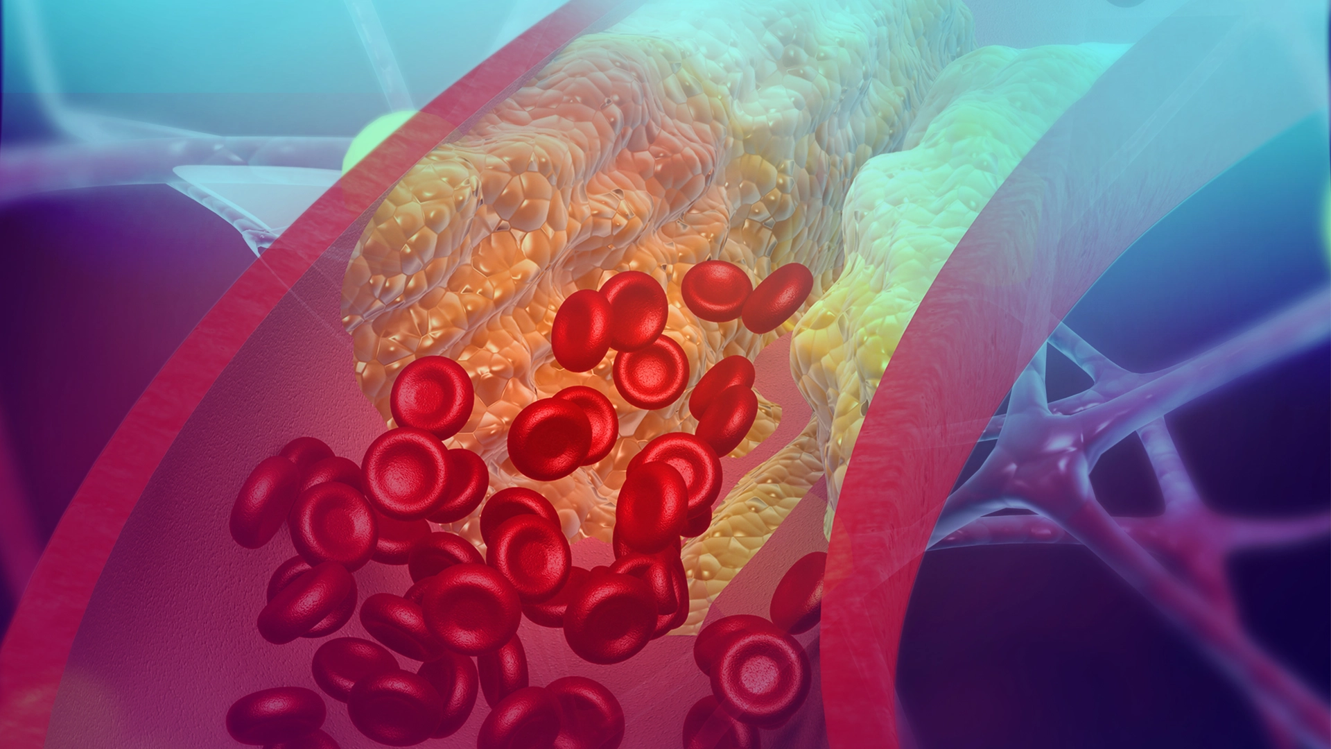 Vielursächliche Rückbildung von Arteriosklerose